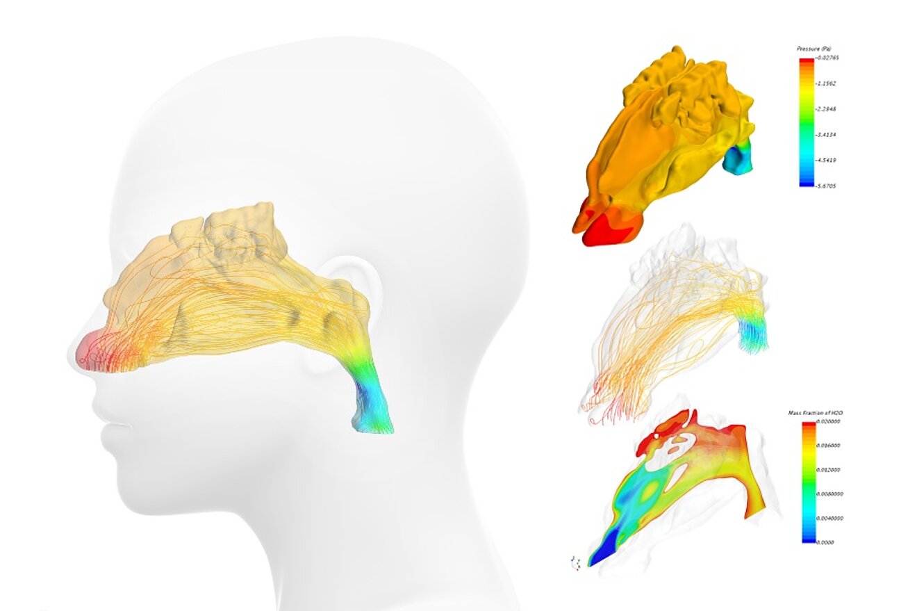 Figure 3 Flow simulation CFD in a nose from a CT scan